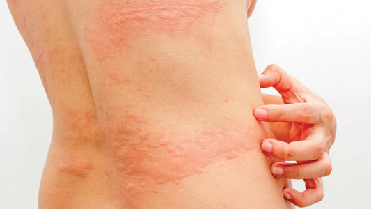 Netelroos, jeuk (urticaria)